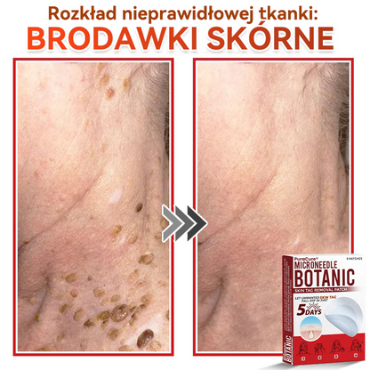 ✅ PuraCure® Plastry do usuwania brodawek i znamion z mikronakłuciami roślinnymi