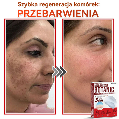 ✅ PuraCure® Plastry do usuwania brodawek i znamion z mikronakłuciami roślinnymi