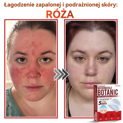 ✅ PuraCure® Plastry do usuwania brodawek i znamion z mikronakłuciami roślinnymi