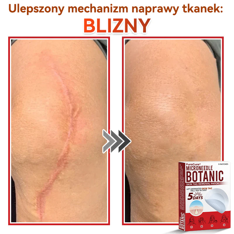 ✅ PuraCure® Plastry do usuwania brodawek i znamion z mikronakłuciami roślinnymi