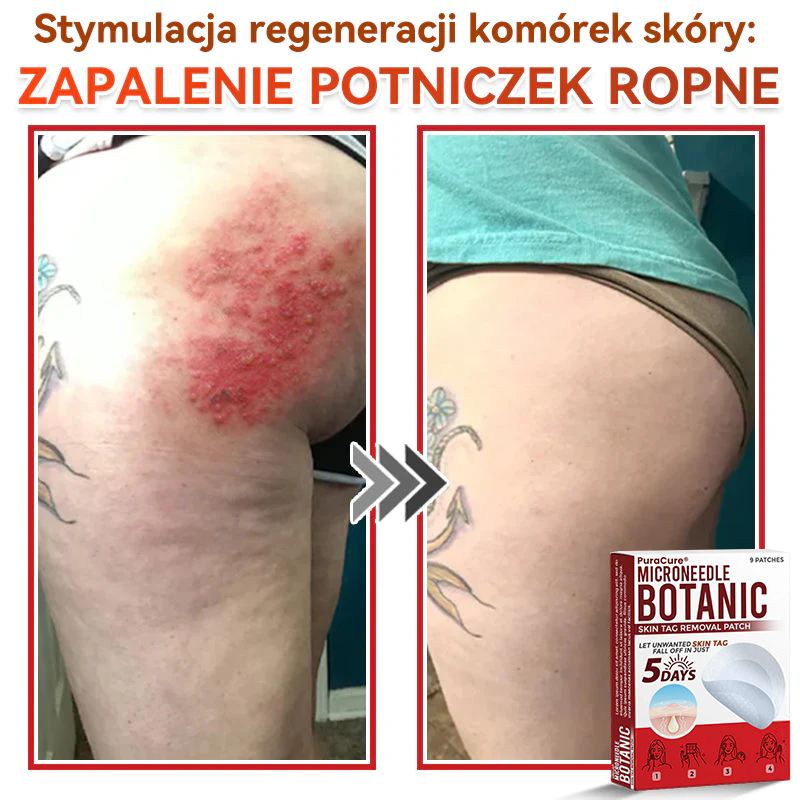 ✅ PuraCure® Plastry do usuwania brodawek i znamion z mikronakłuciami roślinnymi