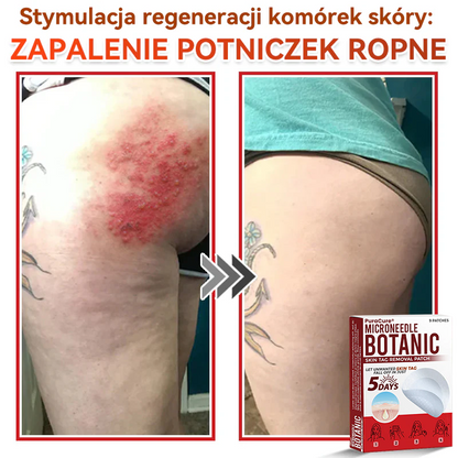 ✅ PuraCure® Plastry do usuwania brodawek i znamion z mikronakłuciami roślinnymi