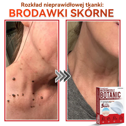 ✅ PuraCure® Plastry do usuwania brodawek i znamion z mikronakłuciami roślinnymi