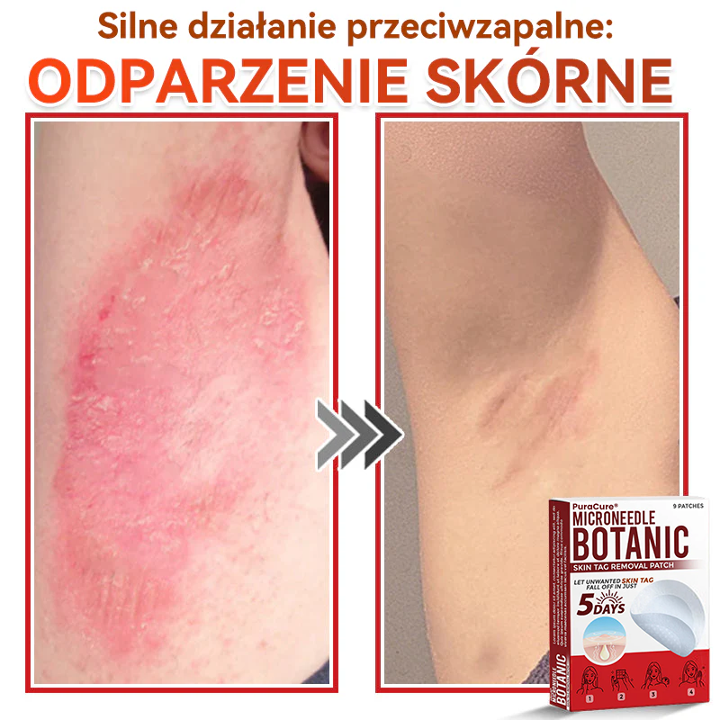 ✅ PuraCure® Plastry do usuwania brodawek i znamion z mikronakłuciami roślinnymi