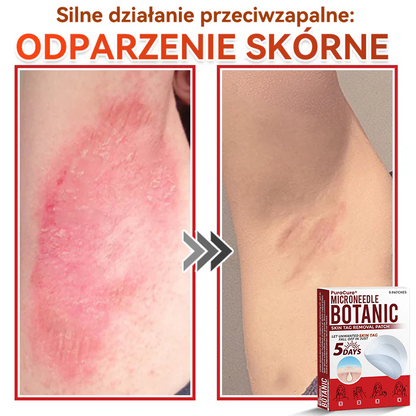 ✅ PuraCure® Plastry do usuwania brodawek i znamion z mikronakłuciami roślinnymi