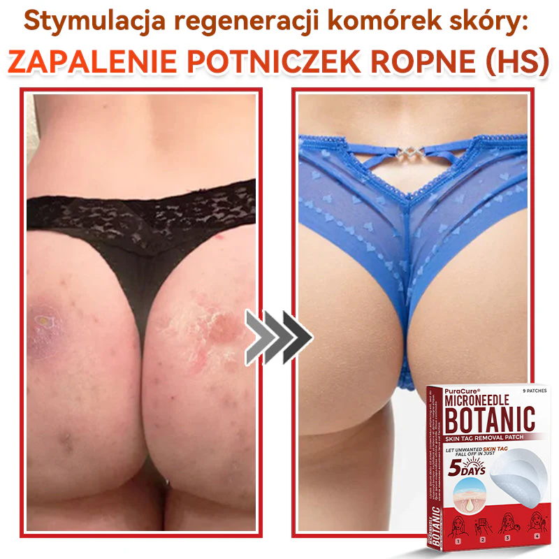 ✅ PuraCure® Plastry do usuwania brodawek i znamion z mikronakłuciami roślinnymi