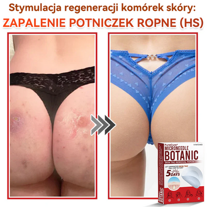 ✅ PuraCure® Plastry do usuwania brodawek i znamion z mikronakłuciami roślinnymi