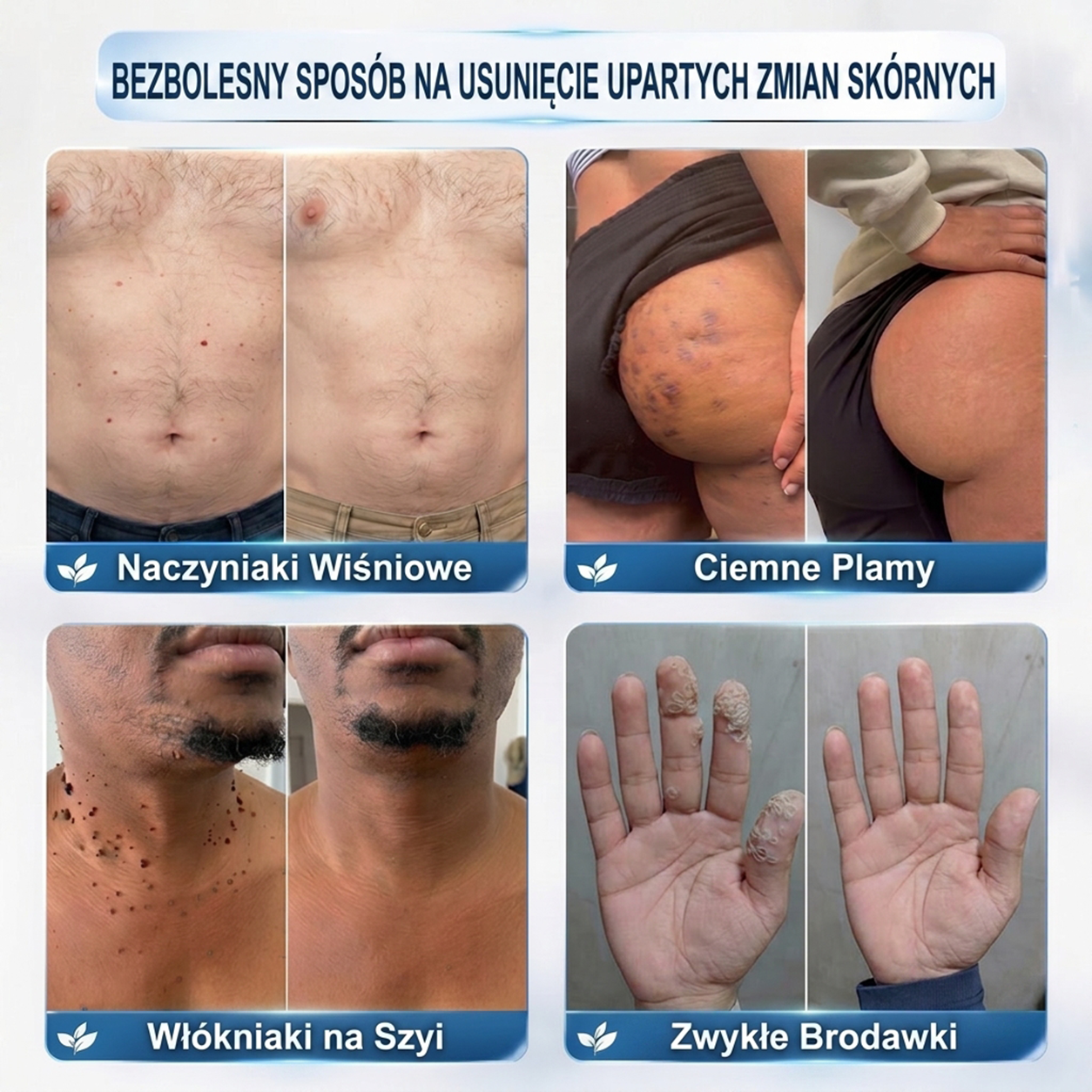 PuraCure® 👩‍⚕️ Pisak do Usuwania Zmian Skórnych i Przebarwień w 7 Dni – Bezbolesna Aplikacja, Bez Powstawania Blizn, Profesjonalny Aplikator Rollerball