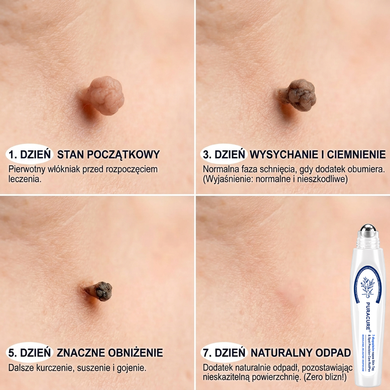 PuraCure® 👩‍⚕️ Pisak do Usuwania Zmian Skórnych i Przebarwień w 7 Dni – Bezbolesna Aplikacja, Bez Powstawania Blizn, Profesjonalny Aplikator Rollerball