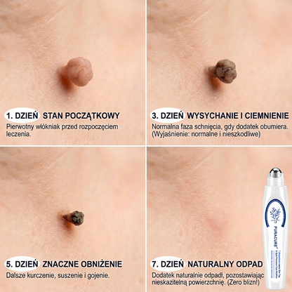 PuraCure® 👩‍⚕️ Pisak do Usuwania Zmian Skórnych i Przebarwień w 7 Dni – Bezbolesna Aplikacja, Bez Powstawania Blizn, Profesjonalny Aplikator Rollerball