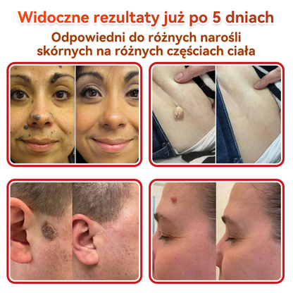 ✅ PuraCure® Plastry do usuwania brodawek i znamion z mikronakłuciami roślinnymi